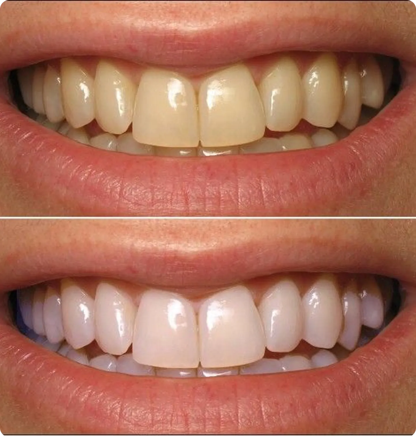 Before and after teeth whitening comparison showing yellowed teeth transformed to bright white